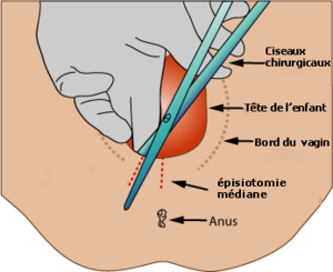 épisiotomie 2